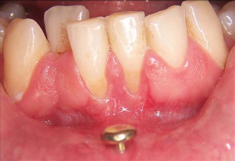Oral Health Risks Of Tongue Piercings News Dentagama