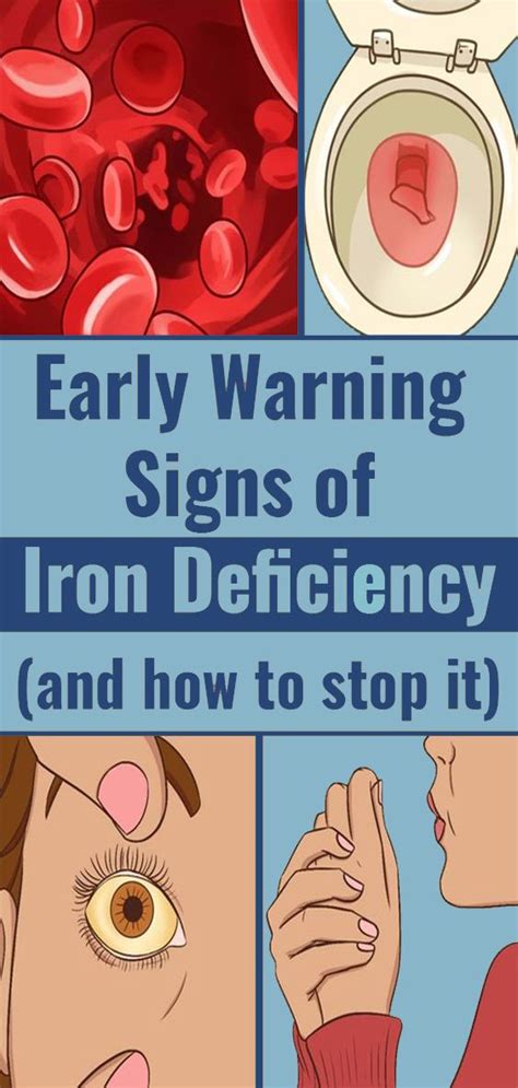 Iron Deficiency Symptoms That You Shouldnt Ignore Medicine Health Life