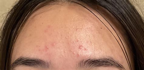 Please Help Dont Know If I Have Fungal Acne Or Comedonal Acne