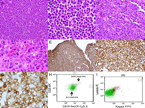 Sentinel Case Of Richter Transformation From Chronic Lymphocytic
