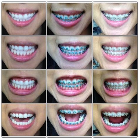 Image Result For Color Options For Braces Tumblr Girls Nails Teeth