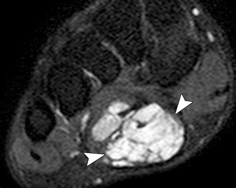 Mr Imaging In The Evaluation Of Cystic Appearing Soft Tissue Masses Of