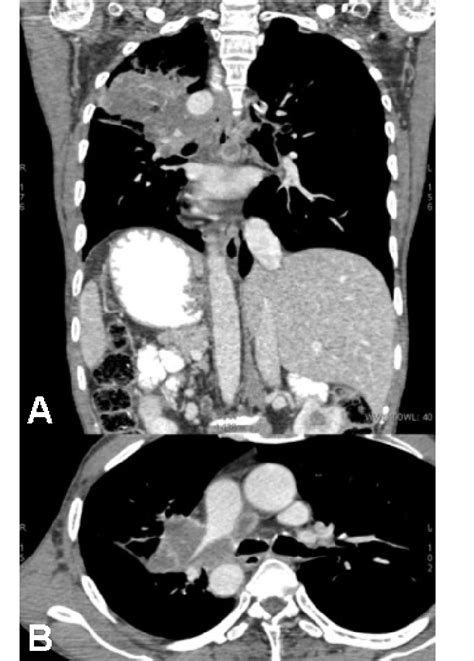 A Contrast Ct Of The Thorax And Abdomen Image Reveals The Mass In