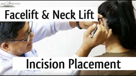 Where Is The Facelift And Neck Lift Incision Youtube