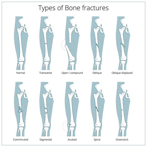 Fracture Types The Vrana Law Firm Personal Injury Attorneys