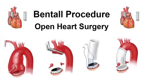 How To Do Bentall Procedure Open Heart Surgery By Dr Yugal Mishra