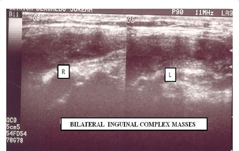 Inguinal Ultrasound Showing Both Bilateral Inguinal Complex Masses