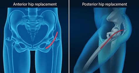 Difference Between Anterior And Posterior Hip Replacement Differences Finder