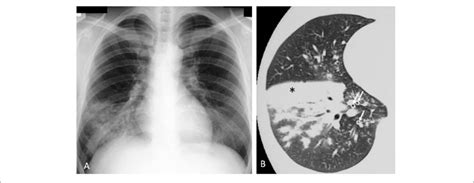 Mycoplasma Pneumoniae Pneumonia In Human A Chest X Ray Shows