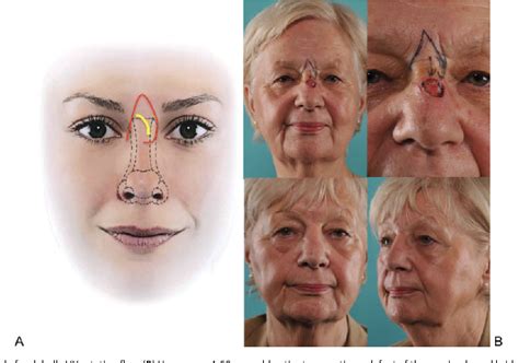 Figure 1 From One Stage Nasal Soft Tissue Reconstruction With Local