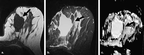 Diffusion Weighted Mr Imaging Of The Breast Academic Radiology