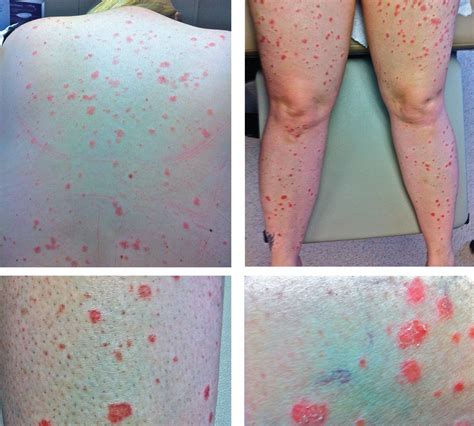 A Rash After Streptococcal Infection Cleveland Clinic Journal Of Medicine