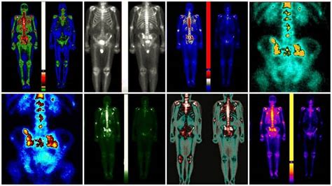 Adding Advanced Pet Scans To Radiation Treatment Plans For Prostate