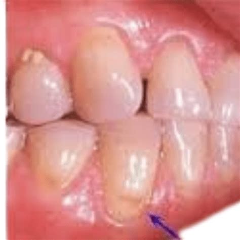 dentin hypersensitivity its causes symptoms and treatment