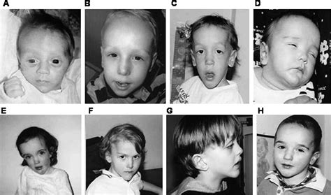 A Clinical Study Of Sotos Syndrome Patients With Review Of The