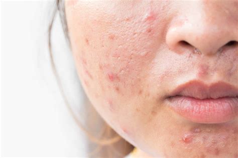 What Ignoring Acnemuhase Can Do To Your Face