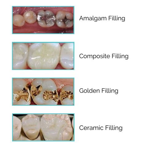 Tooth Filling Stop Tooth Decay Longevita