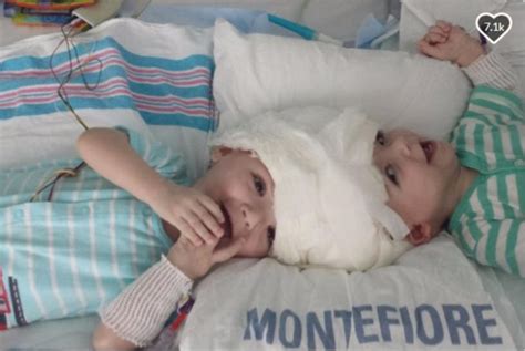 Craniopagus Twins Undergo Separation Surgery
