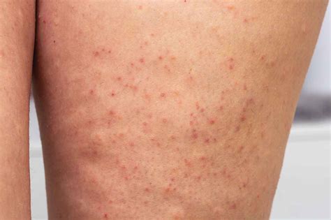 Strawberry Skin Causes Symptoms And Treatments Stylespeak