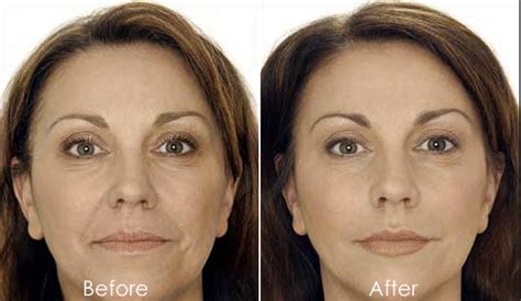 Anti Wrinkle Injections And Filler Specialist Skin Clinic Nuriss
