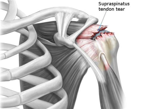 Figure Rotator Cuff Tear Image Courtesy S Bhimji Md Statpearls