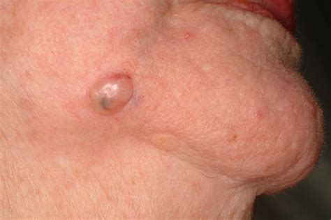 Early Skin Cancer Pictures Lovetoknow