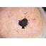 Melanoma Therapies And The Skin  Dermatology Times