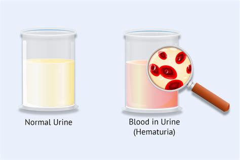 What Causes Hematuria Blood In Urine How To Treat It