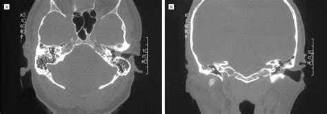 Squamous Cell Carcinoma Of The Temporal Bone A Radiographic Pathologic