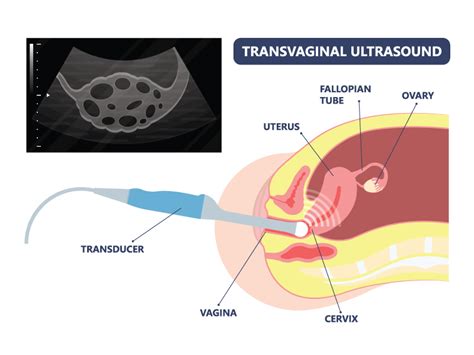 Tvs Ultrasound Transvaginal Scan Test Cost Motherhood Fertility And