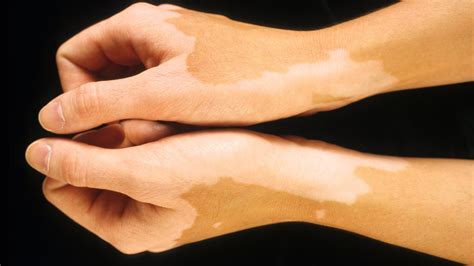 What Causes Light Spots To Appear On Skin