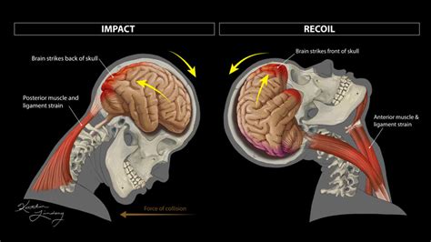 Whiplash And Muscle Strain Illustration By Kaitlin Lindsay