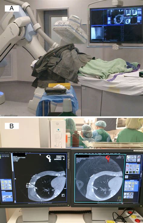 Hybrid Rotational Angiography Guided Localization Single Port Lobectomy