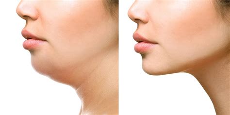 Kybella Nyc Kybella Injections And Treatment For Double Chin