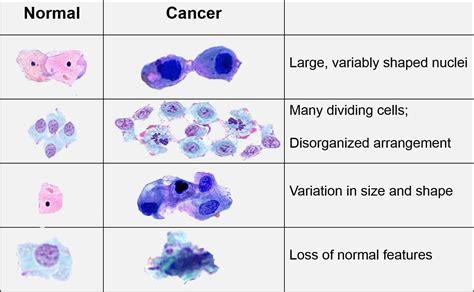 How Cancer Occurs And What Are The Types Of Cancer Cells