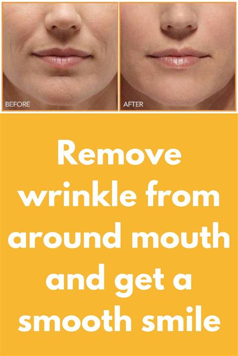 Remove Wrinkle From Around Mouth And Get A Smooth Smile The Wrinkles