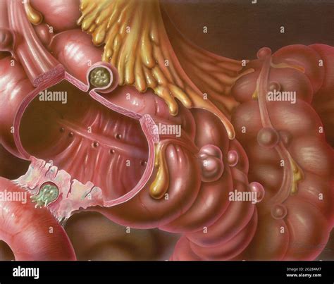 Diverticulosis Of Colon Hi Res Stock Photography And Images Alamy