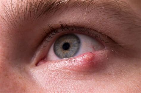 What Is A Stye Plus Eye Stye Causes And How To Get Rid Of A Stye