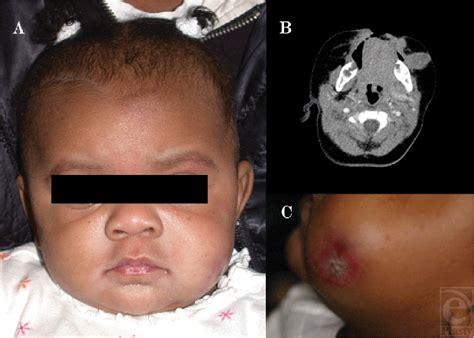 Rapidly Growing Nodular Fasciitis In The Cheek Of An Infant Case