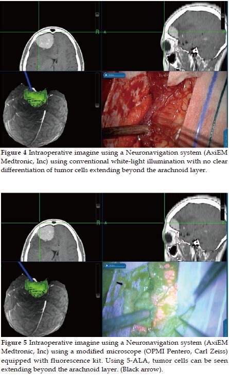 Fluorescence Guided Brain Tumor Surgery Case Report Manrique Guzman