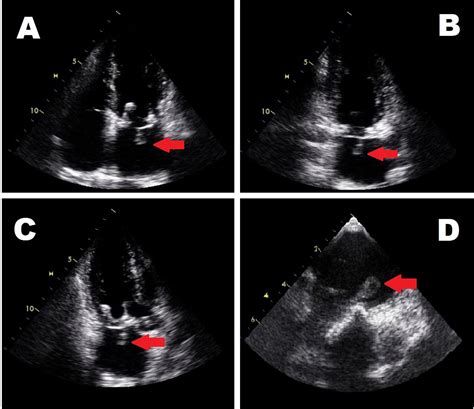 Prosthetic Valve Infective Endocarditis With Mycobacterium Fortuitum