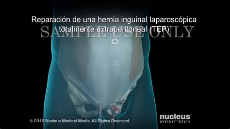 Intervenci N Quirurgica De Hernia Inguinal Youtube