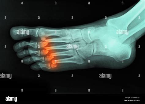 X Ray Of Foot Showing Fractured Metatarsals Stock Photo Alamy