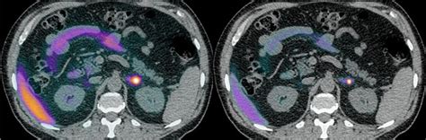 Diagnostics Free Full Text Targeted Molecular Imaging In Adrenal Disease—an Emerging Role