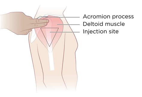 Are you wondering how to give an injection in the buttock? Intramuscular Injection: Definition and Patient Education