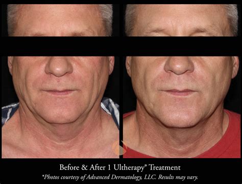 Ultherapy Skin Tightening Procedure Chicago Il Advanced Dermatology