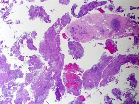 Pathology Outlines Cystic Neutrophilic Granulomatous Mastitis