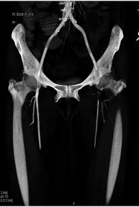 Acute Embolism Occludes The Left Femoral Artery With Bone Edits