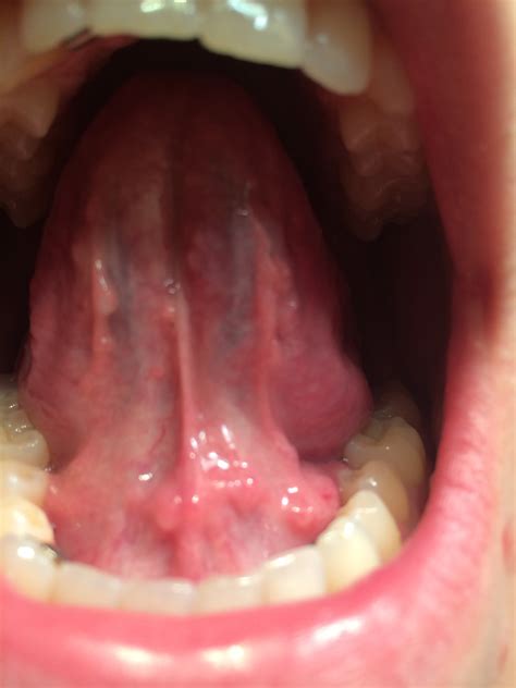 I Have Had Swelling Under My Tongue As Well As Many Pimple