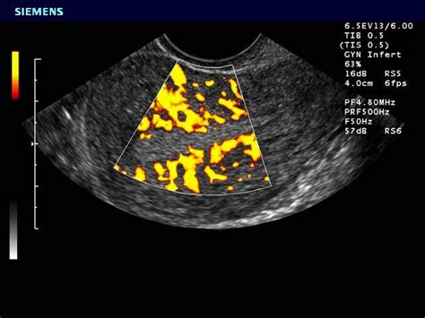 Sag Uterus Transvaginal Power Doppler Of Spiral Arteries